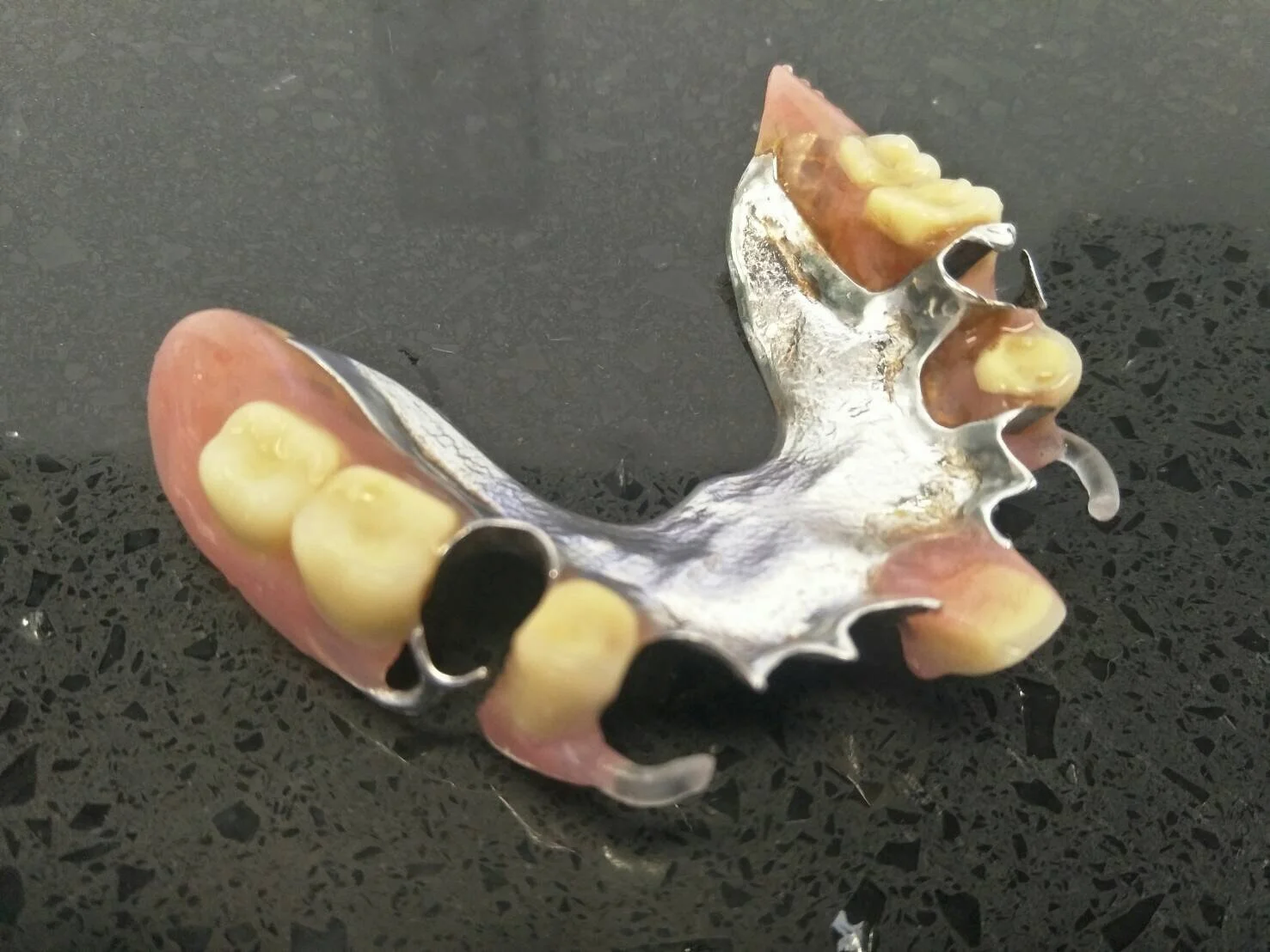 Invisible clear clasp partial denture