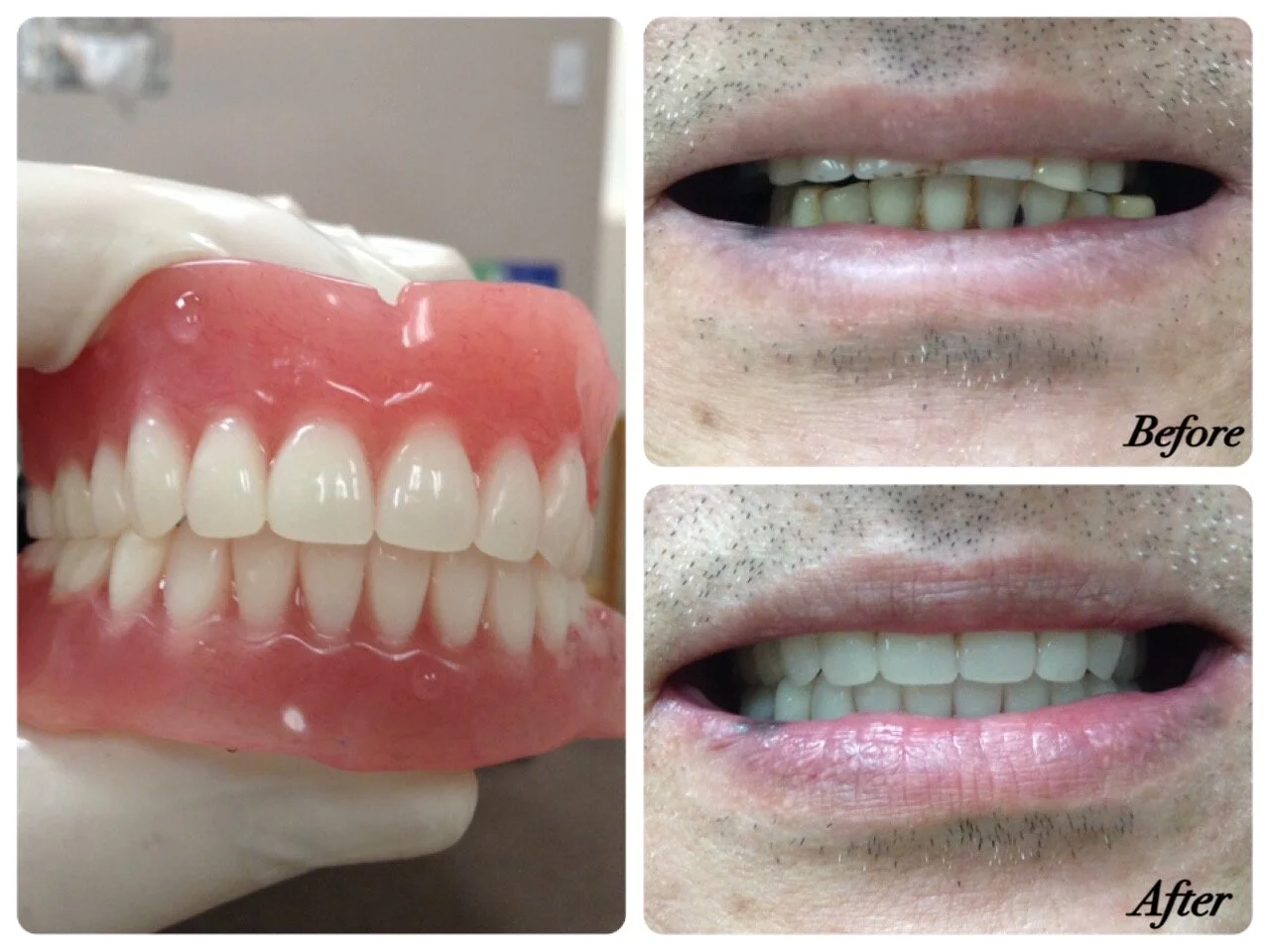 Complete dentures before and after at our Vancouver denture clinic